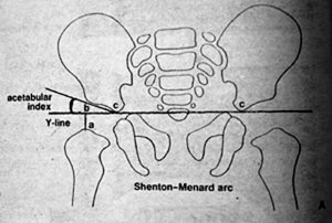 Shenton-Menard arc - Copyright – Stock Photo / Register Mark