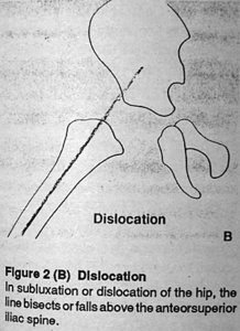 Dislocation - Copyright – Stock Photo / Register Mark