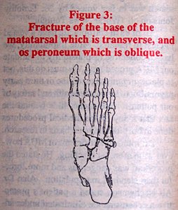 Fracture of the base of the metatarsal which is transverse, and or peroneum which is oblique. - Copyright – Stock Photo / Register Mark