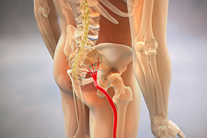 sciatica - Copyright – Stock Photo / Register Mark