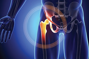 hip rehabilitation - Copyright – Stock Photo / Register Mark