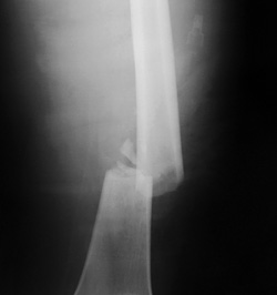 Broken bone - Copyright – Stock Photo / Register Mark