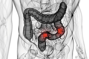 colorectal cancer - Copyright – Stock Photo / Register Mark