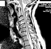MRI study taken a year before the chair incident. - Copyright – Stock Photo / Register Mark