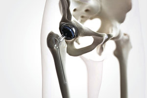 hip replacement - Copyright – Stock Photo / Register Mark