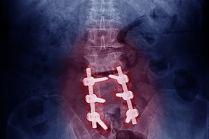 lumbar stenosis - Copyright – Stock Photo / Register Mark