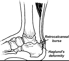 The cavovarus foot - Copyright – Stock Photo / Register Mark