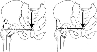 femoral neck angle - Copyright – Stock Photo / Register Mark