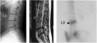 L3 vertebral body - Copyright – Stock Photo / Register Mark