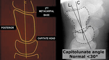 Axis of the capitate - Copyright – Stock Photo / Register Mark