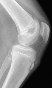 Osgood-Schlatter - Copyright – Stock Photo / Register Mark