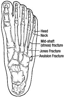 fracture - Copyright – Stock Photo / Register Mark