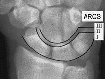 The carpal arcs - Copyright – Stock Photo / Register Mark