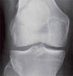 Bipartite patella. - Copyright – Stock Photo / Register Mark