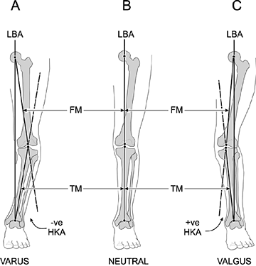 VARUS / VALGUS ALIGNMENT OF THE KNEE - Copyright – Stock Photo / Register Mark