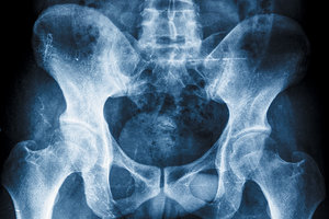 pelvic xray - Copyright – Stock Photo / Register Mark