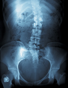 Scoliosis xrays - Copyright – Stock Photo / Register Mark