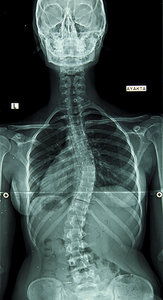 scoliosis xray - Copyright – Stock Photo / Register Mark