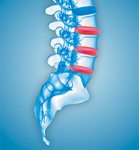 disc pain - Copyright – Stock Photo / Register Mark